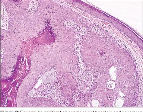 inverted follicular keratosis | Semantic Scholar