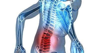 Orthopedic Treatment of Back Sprain