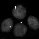 FISH Detection Of TMPRSS2 And ERG Gene Status A No TMPRSS2 ERG