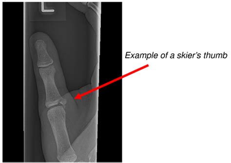 NHSGGC Hand And Finger Fractures