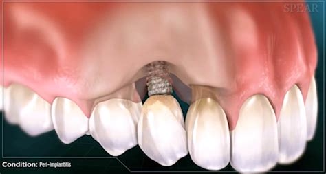 How Can Peri Implantitis Affect My Teeth Implants Dr Kissel Nyc