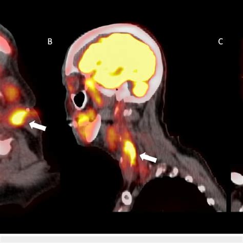 Axial Positron Emission Tomography Computed Tomography Fusion Image