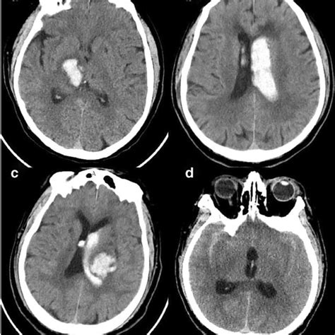 Typical CT images: a intraparenchymal hemorrhage, b intraventricular ...