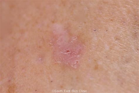 BCC (Basal Cell Carcinoma)