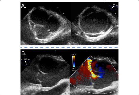 Preoperative Transesophageal Echocardiography A Short Axis Imaging In Download Scientific