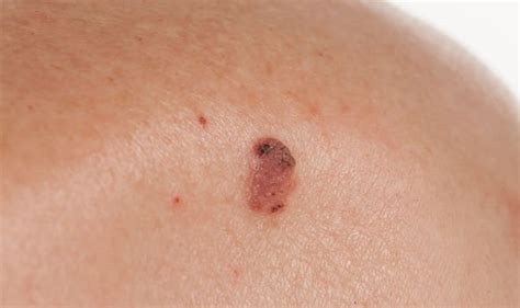 Skin cancer symptoms: Warning signs your mole is melanoma - how to prevent it | Express.co.uk