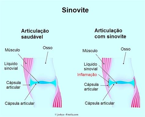 Sinovite No Joelho Reativa