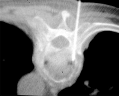 Biopsy Of The T Vertebra Using The Transpedicular Appr Open I