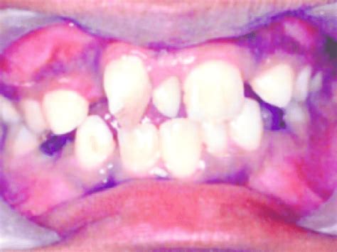 Intraoral Examination Showing Mesiodens With 180 Rotated Central