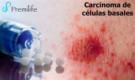 Carcinoma De Células Basales Premilife Homeopathic Remedies