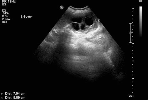 CE 2 Cyst. A 43-year-old female presenting with weight loss. Ultrasound... | Download Scientific ...