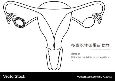 Diagrammatic Of Polycystic Ovary Syndrome Vector Image