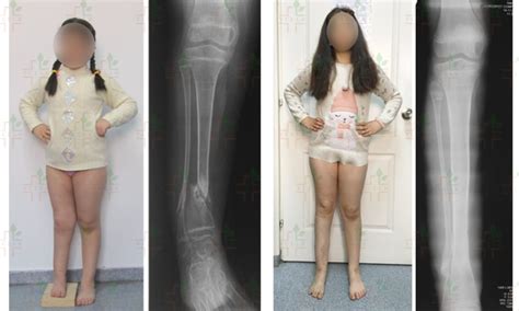 Limb Lengthening And Reconstruction Surgery News Feed