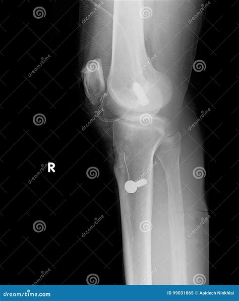 X-ray Of The Knee, Lateral And Posterior Views. Royalty-Free Stock