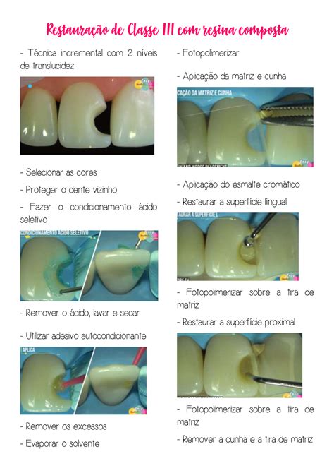 Restaura O Resina Composta Passo A Passo Braincp