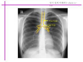 Carina Chest X Ray