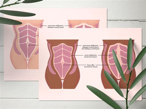 Diastasis Recti Diagram Abdominal Muscles Separation After Etsy