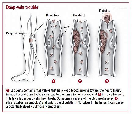 Blood Clot In Leg Ultrasound