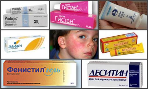 Лучшая мазь от аллергии на коже у взрослых и детей - обзор, советы по ...