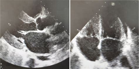 Echocardiography: Parasternal long axis view (A) Four chamber view (B ...