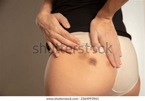 Woman Checking Her Buttock Bruises On Stock Photo Shutterstock