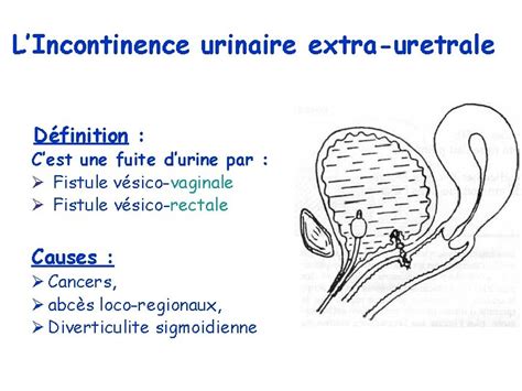 Lincontinence Urinaire De La Personne Ge Une Prise