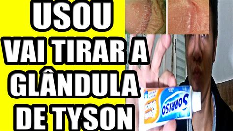 O Que E Glandula De Tyson