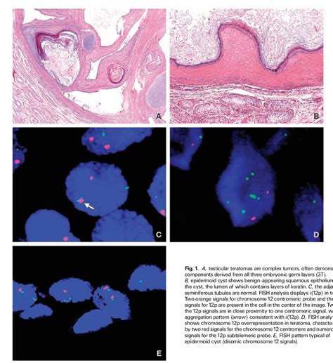 Figure 1 From Interphase Fluorescence In Situ Hybridization Analysis Of