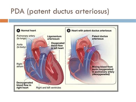 Patent Ductus Arteriosus Signs