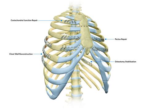 Chest Wall Reconstruction In Abu Dhabi | Chest Wall Surgery Abu Dhabi