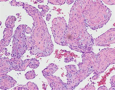 The Histopathological Examination Revealed Cavernous Hemangioma