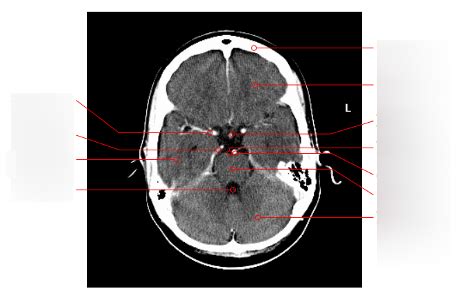 Diagram Radiologie Anatomie Hersenen 5 Quizlet