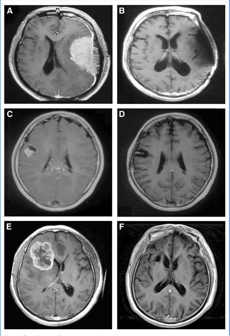 Figure 1 From Clinicopathological Analysis Of Rhabdoid Meningiomas