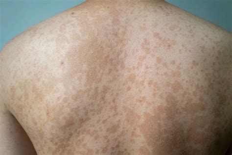 Tinea Versicolor All The Information You Need