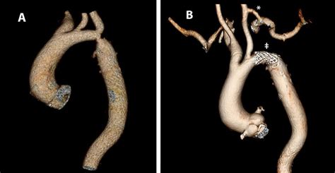 Ct Angiogram Before A And After B Carotid To Left Subclavian Artery Download Scientific