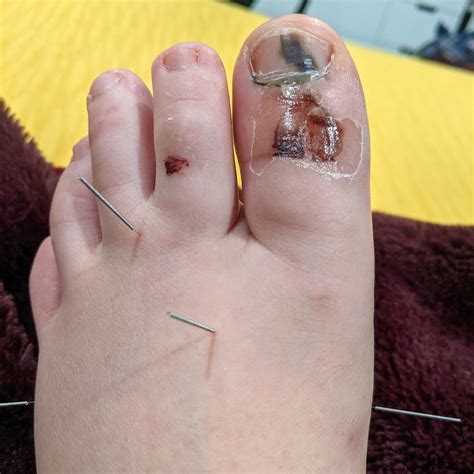 Traditional Chinese Medicine Case Report Broken Big Toe — Alina Rehkopf