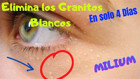 Como Eliminar Los Granitos Blancos En Los Ojos En Solo 4 Dias Millium Youtube