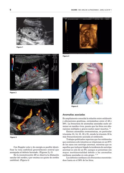 Onfalocele PDF