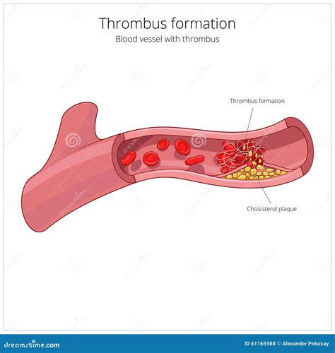 Blood Vessel And Clot Thrombus Vector Illustration Stock Vector