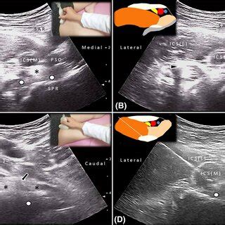 The iliopsoas tendon (*) is encircled by the iliacus muscle when the ...