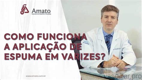 Aplica O De Espuma Em Varizes Como Funciona E Trata As Varizes