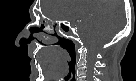 Suprasellar Dermoid Cyst Image