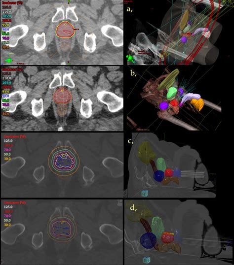 Axial Ct Slide Left And 3d Reconstruction Right Of A Prostate