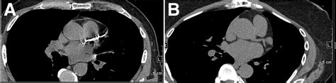 Vascular Calcification The Evolving Relationship Of Vascular