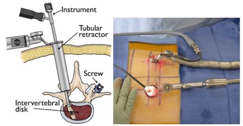 Lumbar Spine Surgery Drsamir Parekh