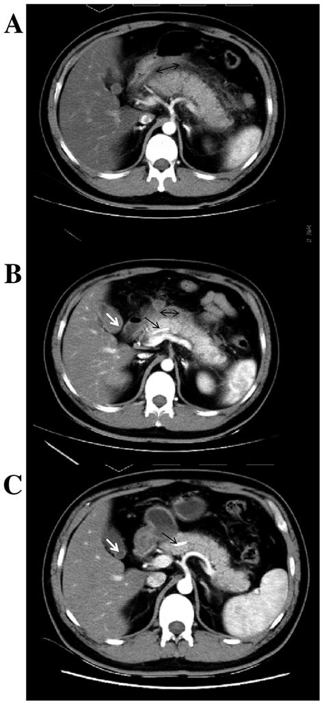 Preoperative imaging features of Case 2. (A) Enhanced CT scan displays... | Download Scientific ...