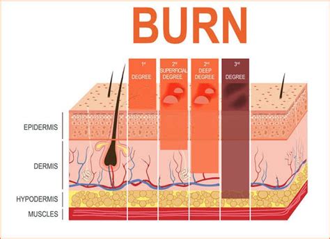 Burns Wound Care In Dubai