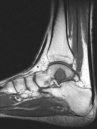 Aneurysmal Bone Cyst Of The Talus Image Radiopaedia Org