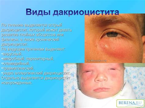 Презентация "дакреоцистит" - скачать бесплатно