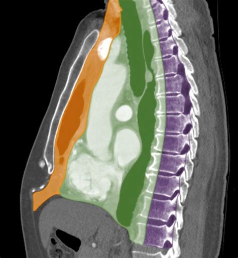 Figure Mediastinum Computed Tomography Scan A Statpearls